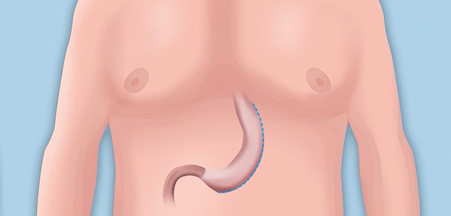 Gastric Sleeve Izmir Surgery – Transparent Pricing and Professional Care