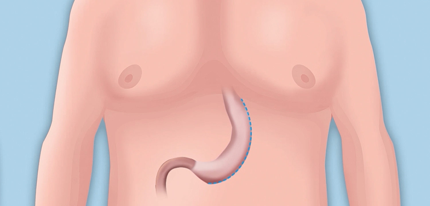 Gastric Sleeve Izmir Surgery – Transparent Pricing and Professional Care